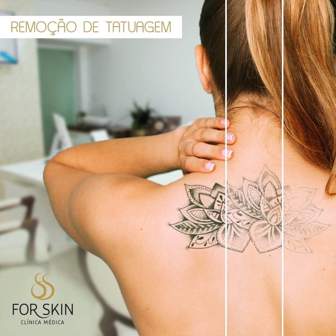 Remoção de tatuagem