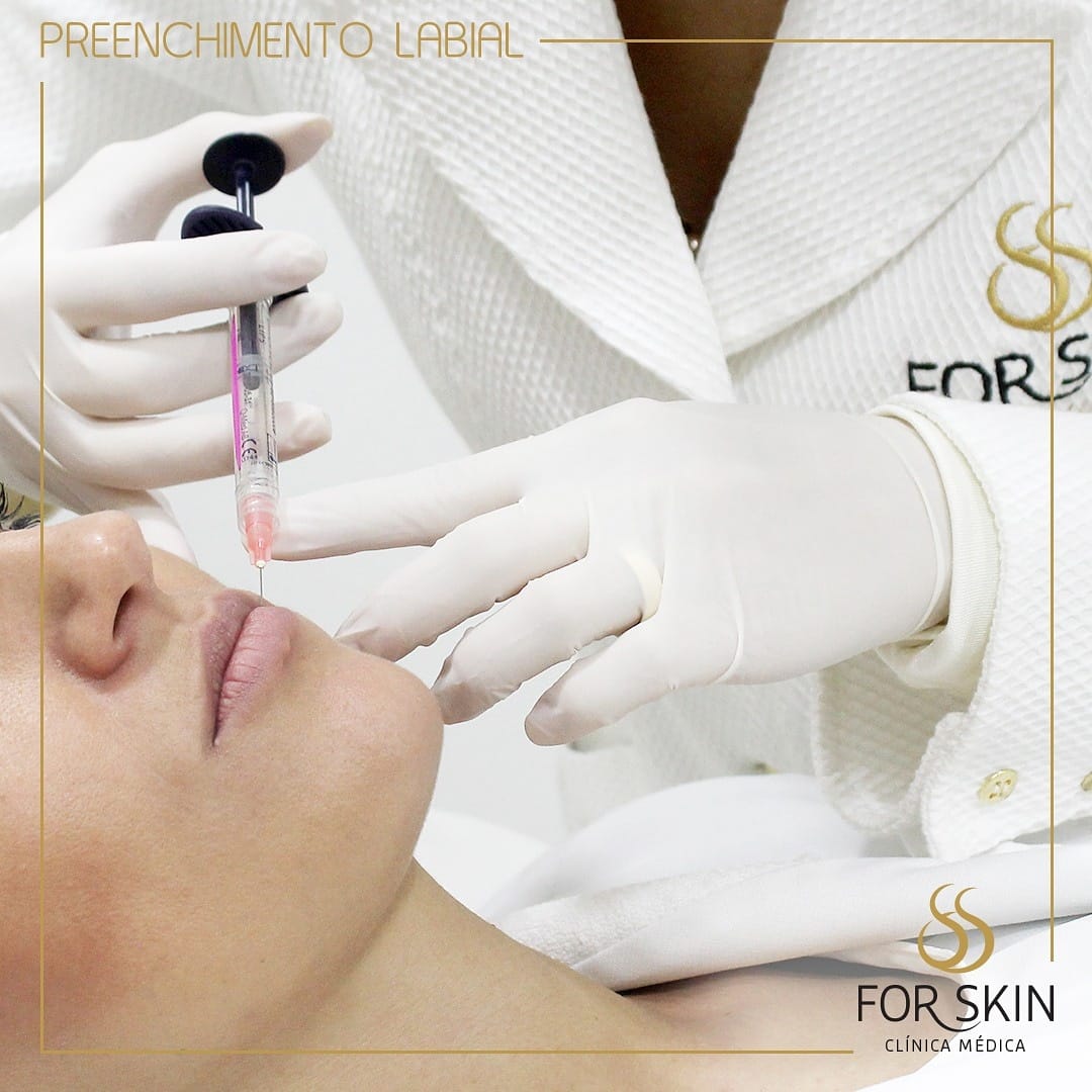 Lábios esteticamente perfeitos com preenchimento labial