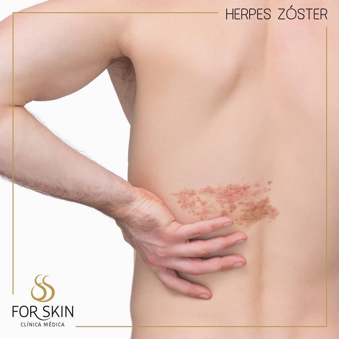 Conheça as condições associadas ao Herpes Zóster